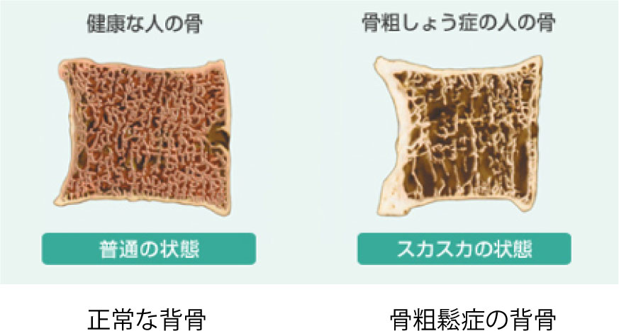 正常な背骨 骨粗鬆症の背骨